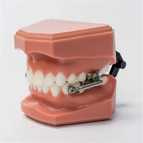 Herbst Appliance - Can Often Correct Severe Overbites without Braces