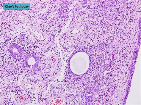 Qiao S Pathology Mixed Endometrial Endocervical Type Of C Flickr