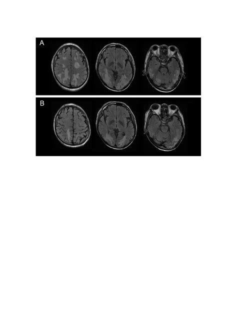 Pdf Posterior Reversible Encephalopathy Syndrome In A Patient With