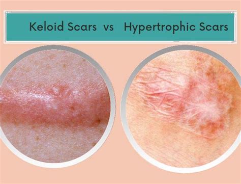 Keloid Scars Vs Hypertrophic Key Differences You Should Know Awd Med