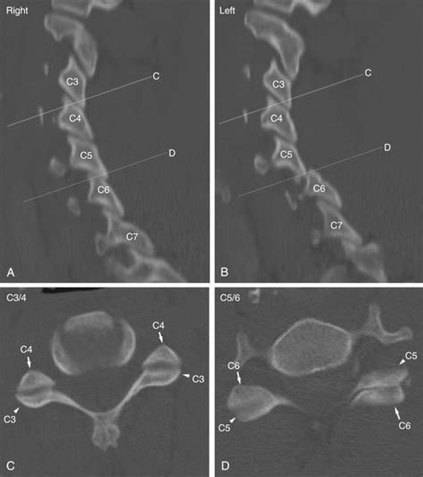 Subaxial Cervical Spine Trauma Clinical Tree