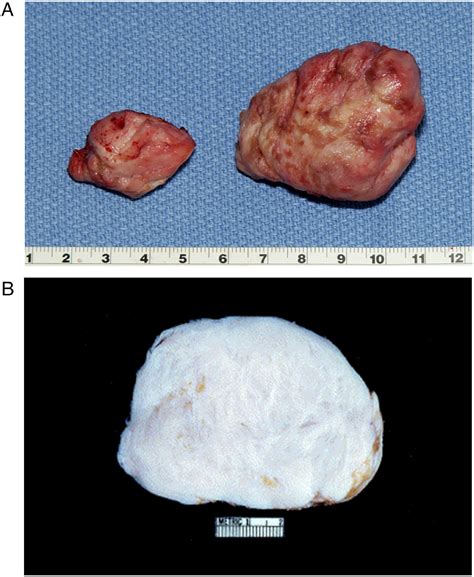 Clinical Impact Of Cardiac Fibromas American Journal Of Cardiology