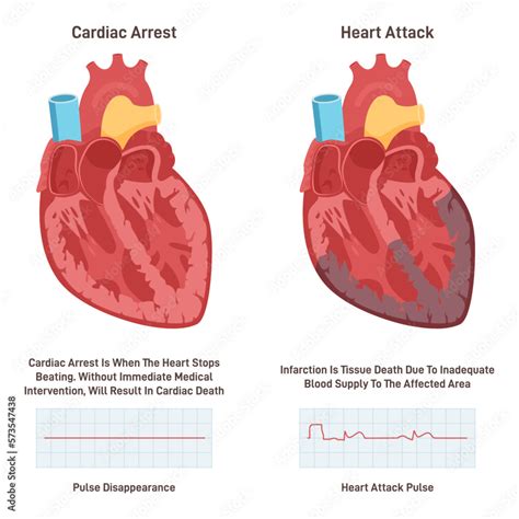 Cardiac Arrest Vs Heart Attack Heart Diseases Comparison Electrical