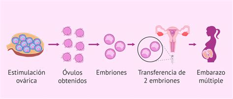 Embarazo Múltiple Por Fecundación In Vitro Fiv