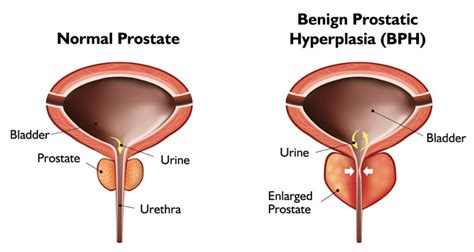 Enlarged Prostate Benign Prostatic Hyperplasia Bph Franciscan Missionaries Of Our Lady Health