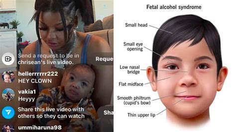 Does Crisean Baby Have Obvious Fetal Alcohol Sydrome Poor Baby Youtube