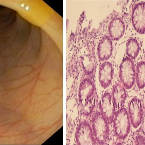 Colonoscopy And Colonic Biopsy Showing Chronic Mucosal Inflammation