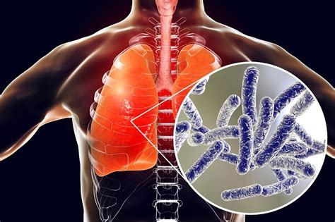 Allarme Legionella Cos E Come Prevenirla Erogatori Acqualys