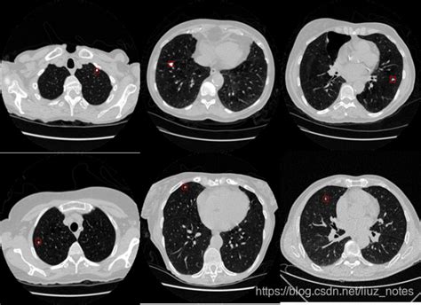 基于深度学习的肺部ct影像识别——采用u Net、3d Cnn、cgan实现肺结节的检测（一）生物信息通过图片训练找到结节 Csdn博客