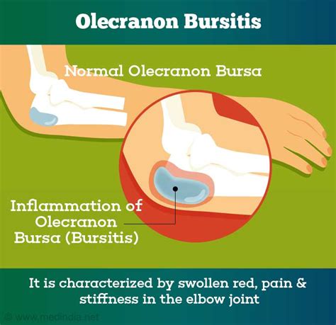 Septic Olecranon Bursitis