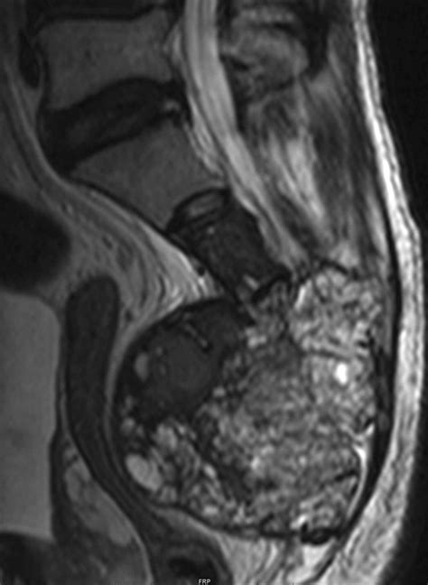 Mri Findings Of Giant Cell Tumors Of The Spine Ajr