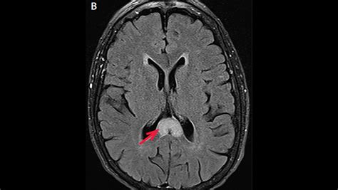 Corpus Callosum Lesions - The Neurology Hub