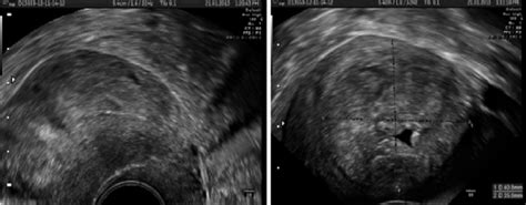 Uterus Postlaparoscopic Wedge Resection And Repair Download