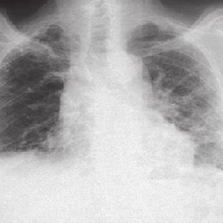 Postero Anterior Chest X Ray Of The Patient Chest X Ray Of The Patient