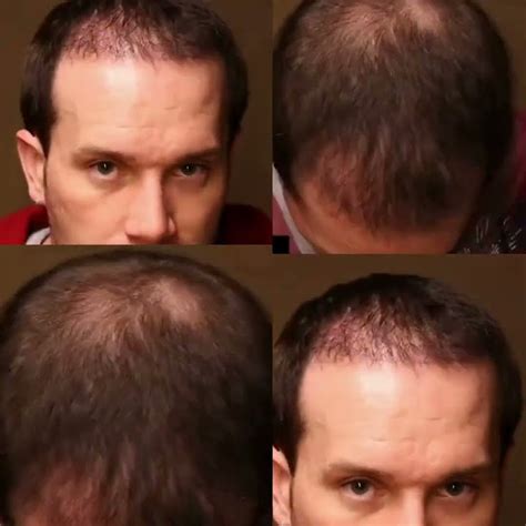 Affirmative Hair Solutions Hair Transplant Time Lapse