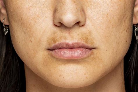 Skin Pigmentation Brown Patches