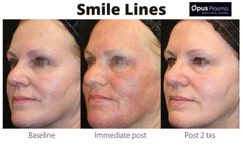 Opus Plasma Non Surgical Skin Treatment Medical Spa Botox Laser