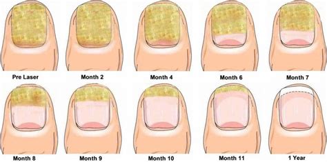 Laser Nail Fungus Treatment – WESTON HCG CENTER