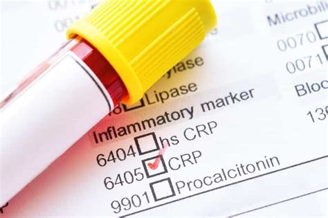 Understanding Inflammatory Markers: Everything You MUST Measure For ...