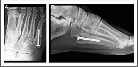 Figure 6 From Fifth Metatarsal Jones Fractures In The Athlete Semantic Scholar