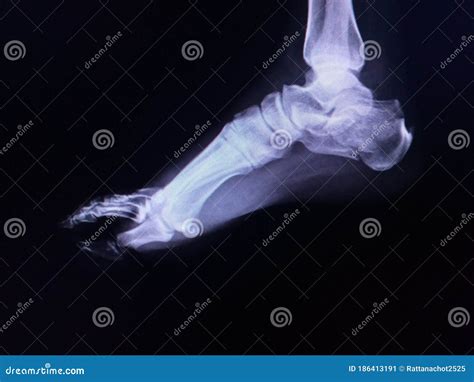 Film Ankle X Ray Radiograph Showing Heel Bone Broken Close Fracture