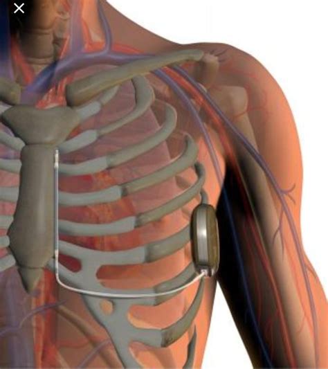 Automatic Implantable Cardioverter Defibrillators (AICD or ICD ...