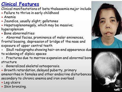 Thalassemia Syndromes Ppt Video Online Download