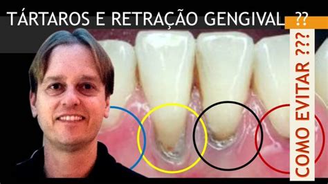 Como prevenir e tratar o tártaro na raiz do dente Actualizado enero 2025