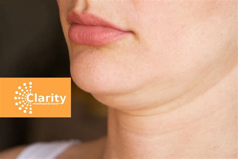 Effective Ways To Get Rid Of Double Chin Clarity Medspa