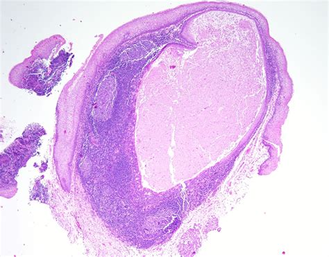 Lymphoepithelial Cysts