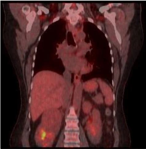 Figure 1 From Triple Synchronous Primary Malignancies Of The Colon