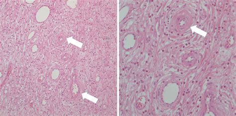 (A, B) Histology was compatible with inflammatory fibroid polyp ...