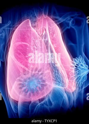 Pneumoconiosis Lung Disease Illustration Stock Photo Alamy