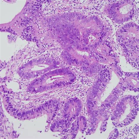 Colonic Biopsy Hematoxylin And Eosin Stain Showing Well‐differentiated Download Scientific