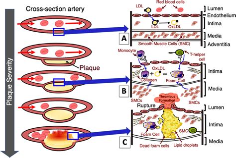 Schematic Of Atherosclerotic Plaque Progression In Arteries A