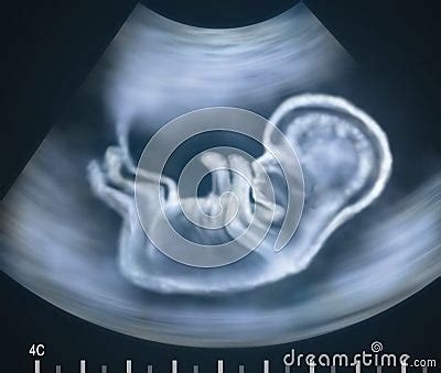 Ultrasound Image Of Baby In Mother S Womb Royalty Free Stock