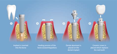 Dental Implants Enhance Dental Care