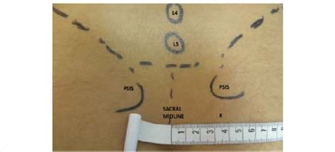 Positioning For A Landmark Guided Sacroiliac Joint Injection The