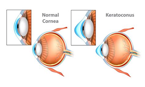 Keratoconus Causes Signs Symptoms And Treatment