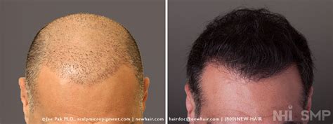 Smp Scalp Micropigmentation And Hair Transplant With Long Hair