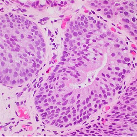 Case 4 Invasive Adenosquamous Carcinoma Adsq Involving The Anus A