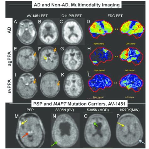 Examples Of Av Pet Scans In Subjects With Various Diseases