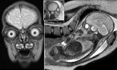 Are These Aliens Or Human Babies Mind Boggling MRI Scans Of