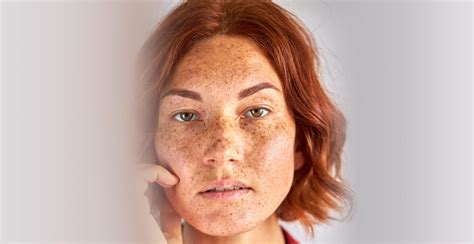 Todo Lo Que Necesitas Saber Sobre El Melasma Causas Síntomas Diagnó