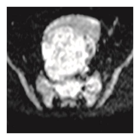 A T1 Weighted Magnetic Resonance Imaging Depicting A Mass In The