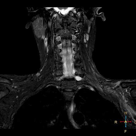 Brachial Plexus Injuries Radiology Reference Article Radiopaedia Org