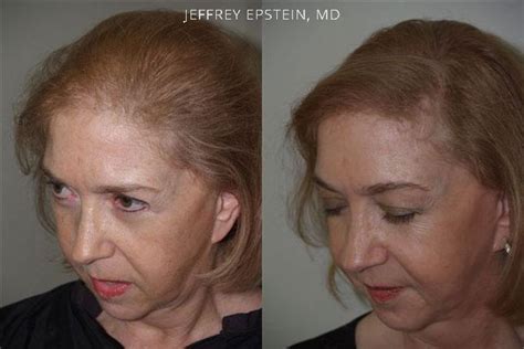 Hair Transplants For Women Photos Miami Fl Patient41771