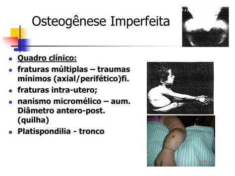 Ppt Osteog Nese Imperfeita Powerpoint Presentation Id