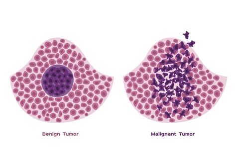 Benign Vs Malignant Tumors What S The Difference