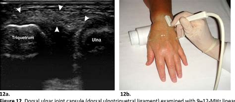 Ulnar Collateral Ligament Wrist